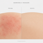 Barriera e rossori prima e dopo - immagine illustrativa